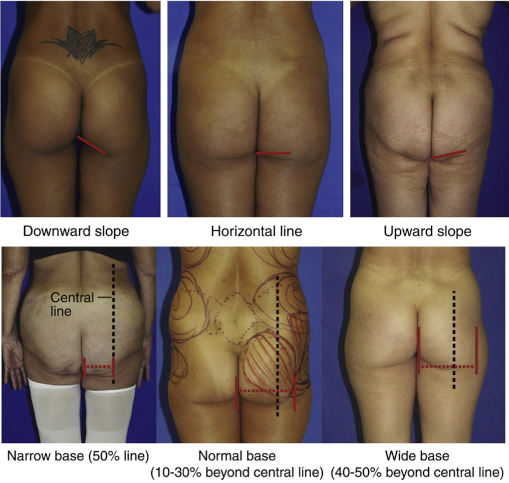 Gluteal Aesthetic Unit Classification