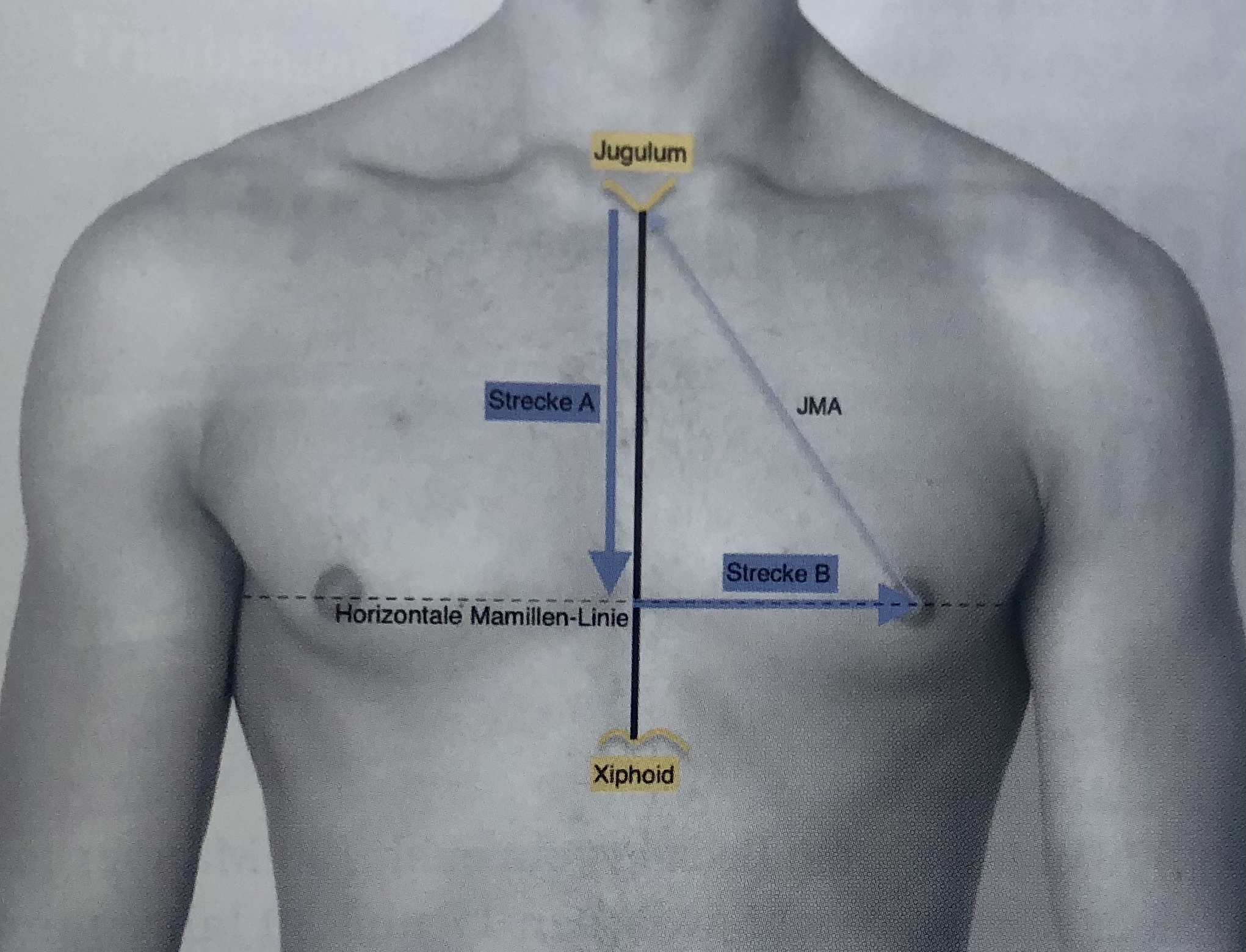 The Aesthetically Ideal Position of the Nipple–Areola Complex on the Breast