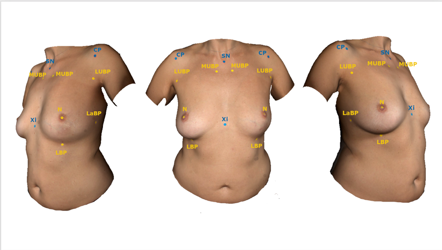 A New Tool for Breast Anthropometric Measurements: Presentation